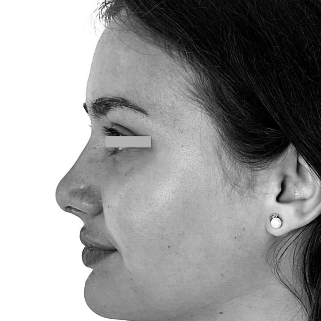 After — Dr. Chacra’s patient 1, side profile
