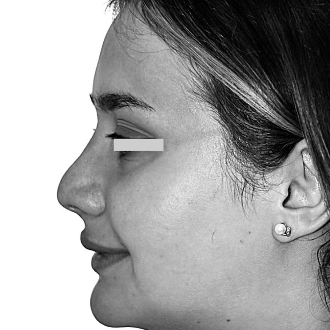 Before — Dr. Chacra’s patient 1, side profile