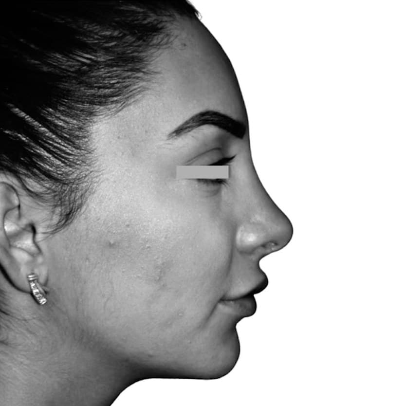 After — Dr. Chacra’s patient 2, side profile