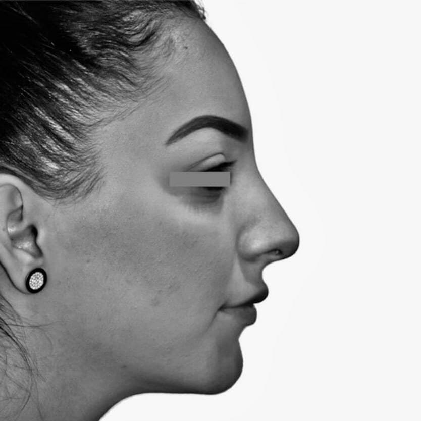 Before — Dr. Chacra’s patient 2, side profile