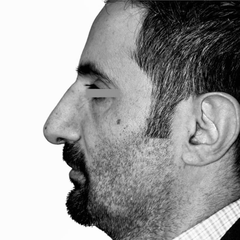After — Dr. Chacra’s patient 3, side profile