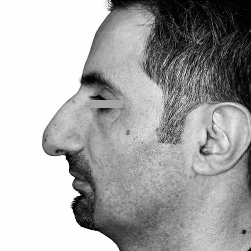 Before — Dr. Chacra’s patient 3, side profile